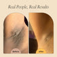 Roller Remover (ingrowns and dark spots)